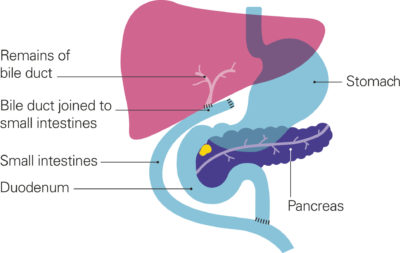 What does bypass surgery involve? - Pancreatic Cancer UK