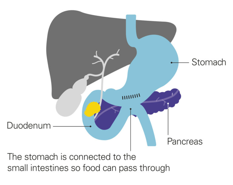 What does bypass surgery involve? - Pancreatic Cancer UK