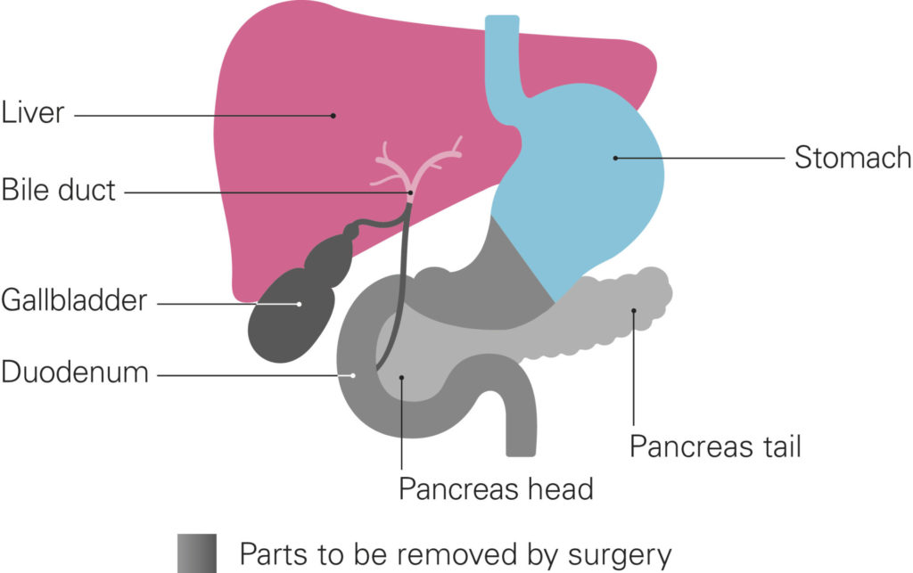 Types of surgery for pancreatic cancer - Pancreatic Cancer UK