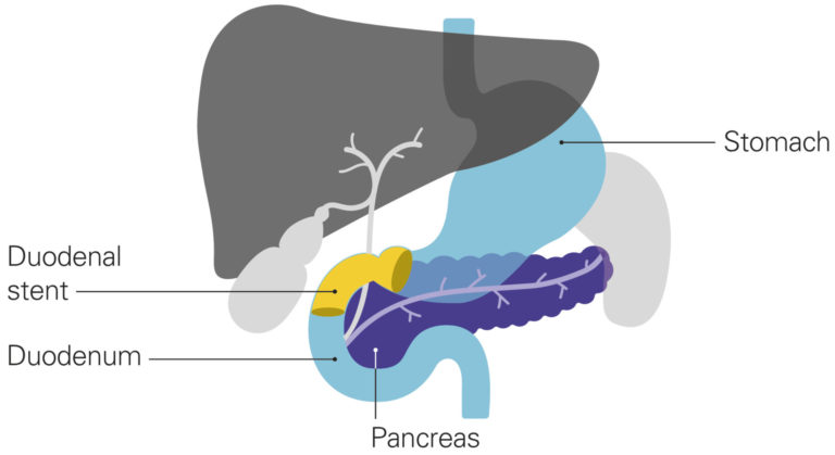 Stents for a blocked duodenum - Pancreatic Cancer UK