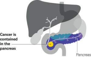 Stage 1 pancreatic cancer - Pancreatic Cancer UK