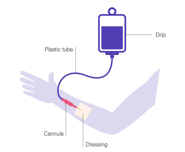 How is chemotherapy given? - Pancreatic Cancer UK