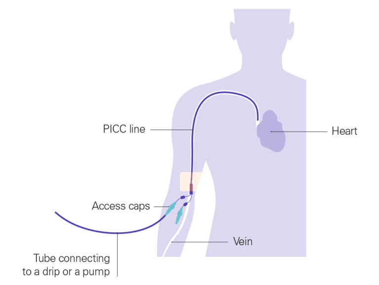 How is chemotherapy given? - Pancreatic Cancer UK