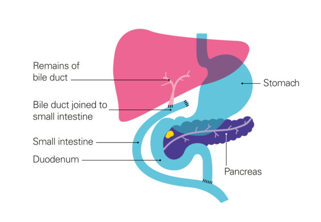 What does bypass surgery involve? - Pancreatic Cancer UK