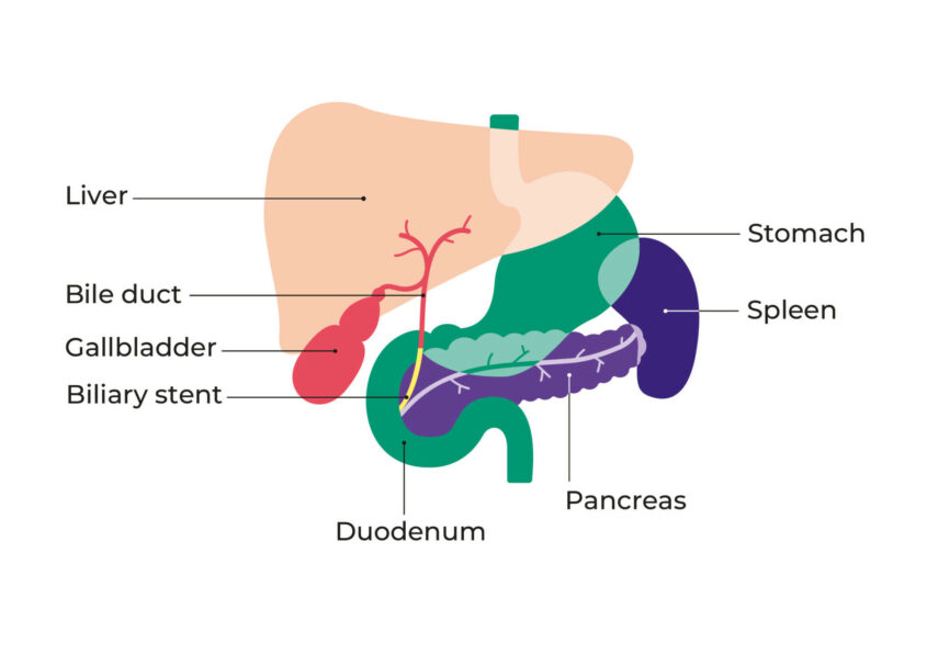 Diagram showing the placement of a biliary stent within the bile duct