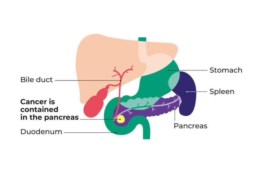 Diagram showing stage 1 pancreatic cancer with the cancer contained within the pancreas