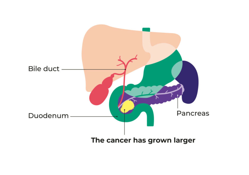 Diagram showing stage 2 pancreatic cancer. Shows the cancer in the pancreas and spreading close to the pancreas