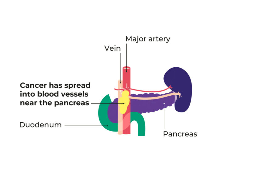 Diagram showing stage 3 pancreatic cancer. shows the cancer in the pancreas and spreading to blood vessels close to the pancreas