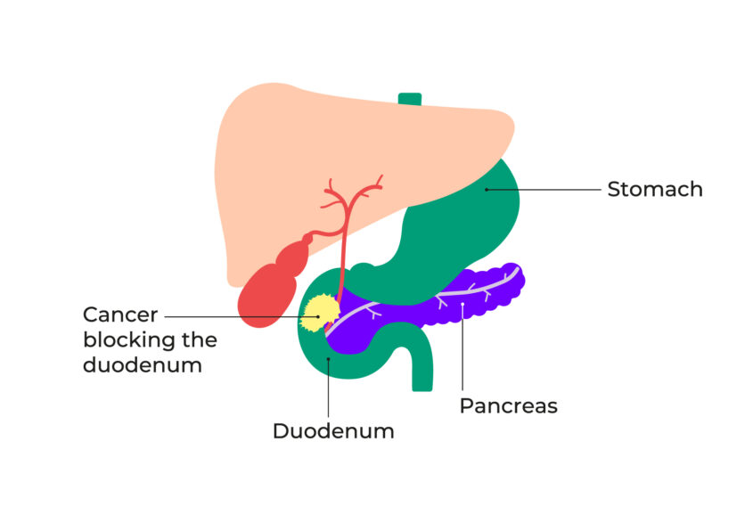 Diagram showing how the cancer blocks the duodenum