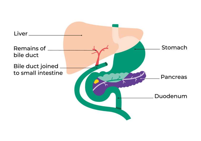 Diagram showing the parts removed by surgery and how it bypasses the blockage in the bile duct