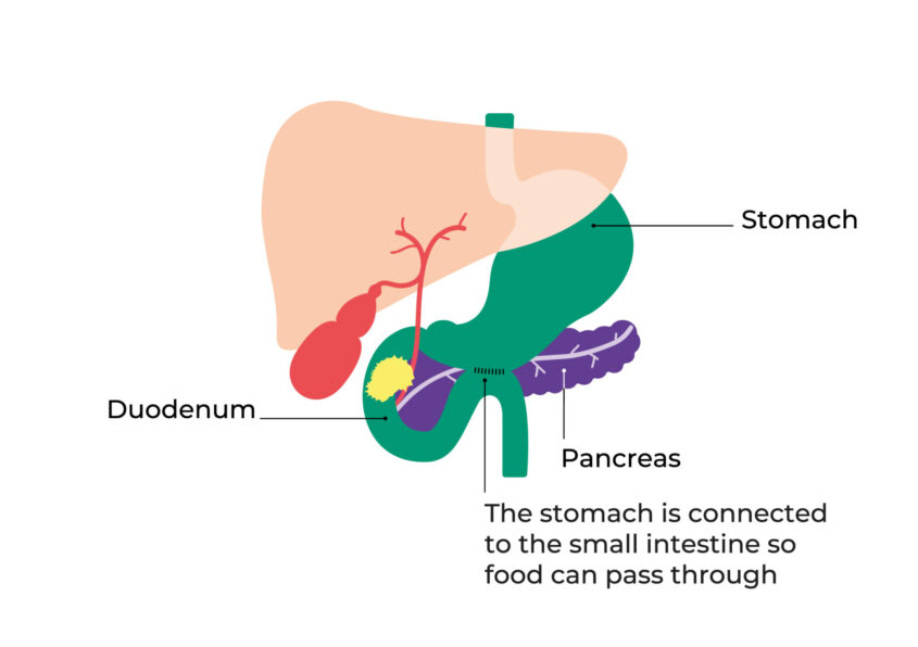 Diagram showing how surgery bypasses the blockage in the duodenum