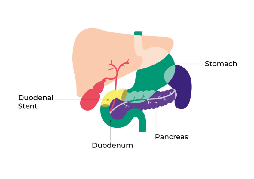 Diagram showing where a duodenal stent is positioned